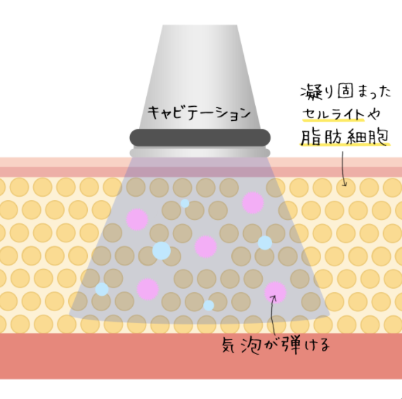 キャビテーションの説明 | 痩身効果の説明 | ダイエット初心者向けに ...